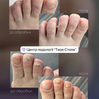 подолог, педикюр, нігті