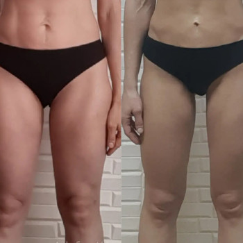 Фото с портфолио Центр апаратної корекції фігури «Slim»