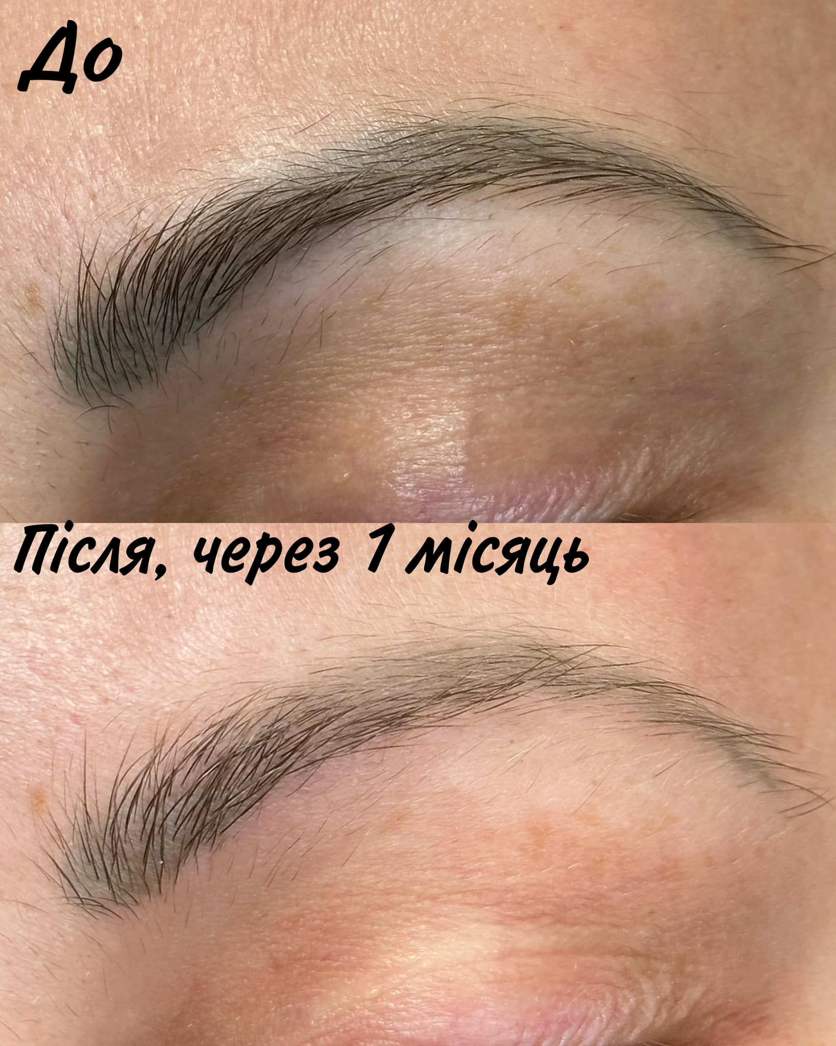 Удаление татуажа лазерное ремувером, фото - Мастер татуажа Оксана Ткаченко