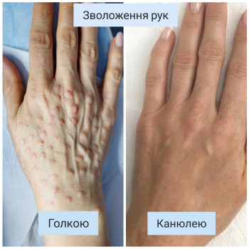 Зволоження рук голкою та канюлею
