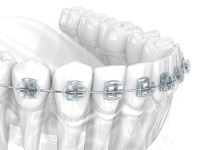 Знижка -6% на металеву брекет-систему American Orthodontics! Стоматологія Люми-Дент Київ