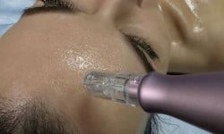 Екзосомна терапія з Dermapen Студия лазерной эпиляции Центр лазерної косметології Луцк
