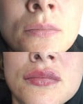 Збільшення губ 1ml Врач-косметолог Олеся Музичка Тернополь