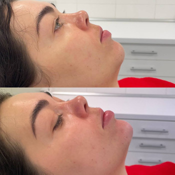 контурна пластика підборіддя