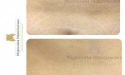 Лазерне видалення розтяжок Медицинские услуги Клініка естетичної медицини Мирослави Новосільскої Ужгород