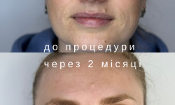 RF ліфтинг Косметология Laser Impulse Тернополь