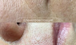 Електроепіляція Косметология Laser Impulse Тернополь