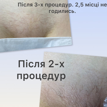 Результати неймовірні. Вже після 3-х повних проходів ділянки зони бікіні, маємо ось такий результат. Через 2,5 місяці маємо ось таку кількість волосків які вийшли на поверхню шкіри. Шкіра гладенька без шрамів.