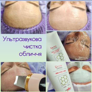 Чиста шкіра вже після першої процедури.