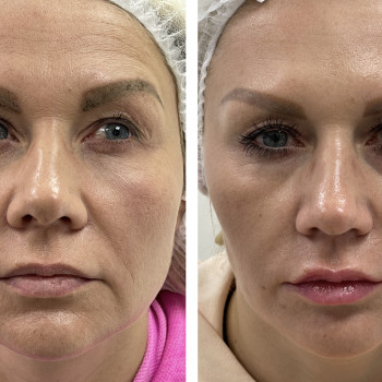 Full face ботокс