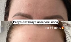 Ботулінотерапія Майстер татуажу  Полтава