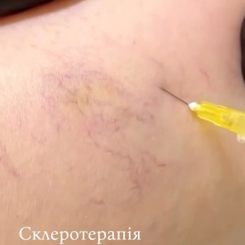 Доглянуті ноги у будь-яку пору року 🤍 Після склеротерапії шкіра виглядає більш рівною та естетичною.