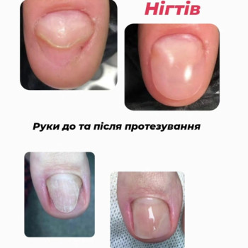 Протезування нігтів, руки та ноги)))