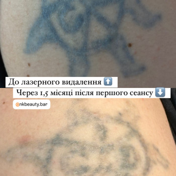 Лазерне видалення тату