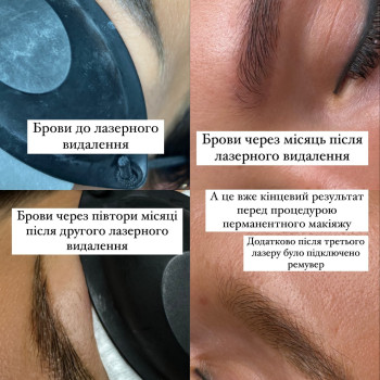 Результат видалення татуажу (лазер + ремувер)
