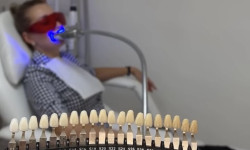 Відбілювання зубів Косметолог-естетист Ольга Чернігів