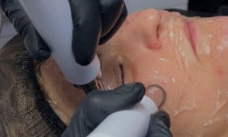 Мікрострумова терапія Косметолог-эстетист Ольга Чернигов