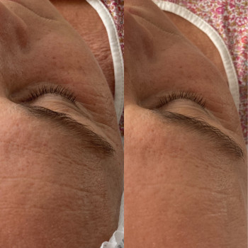 Масаж обличчя Biomorphodermia (Face forming, Face lifting)