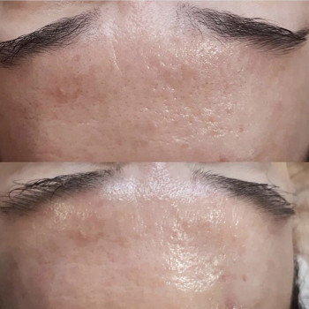 ПРОЦЕДУРА ANTI-AGE PEELING з сироваткою-міорелаксантом MTRX 🧬 Фото ефекту одразу після процедури ✨ 💉 ANTI-AGE PEELING — поверхневий всесезонний антивіковий пілінг, спрямований на корекцію та профілактику вікових змін шкіри.