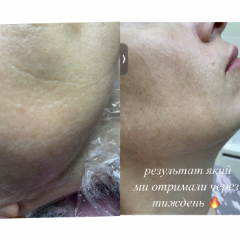 Корекція заломів на щоках, 1 процедура препаратом Belotero Soft