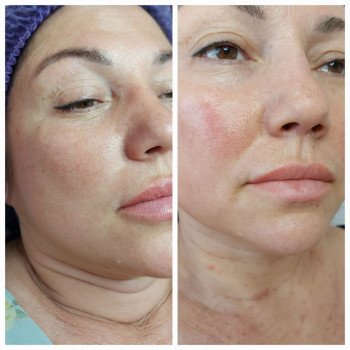 хочу поделиться результатом одной процедуры Miore Collagen. Работала иглой