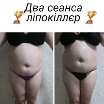 Ліпокіллєр