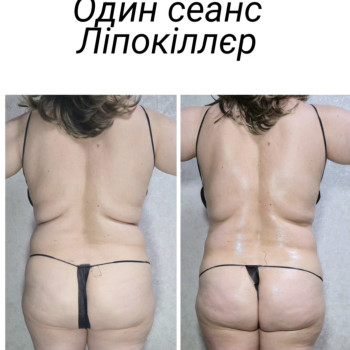 Один сеанс Ліпокіллєр
