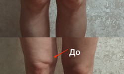 Медовый массаж / выкатка мёдом Массажист  Полтава