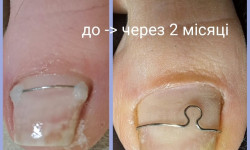 Медичний педикюр Майстер манікюру Ярина Вишневе