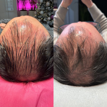 корекція алопеції - результат проміжний, 2 процедури. DR CYJ Hair Filler