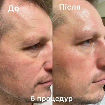 6 процедур для омолодження