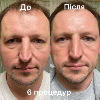 6 процедур для омолодження