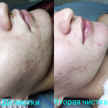 Чистка обличчя