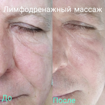 1 сеанс лімфодренажного масажу