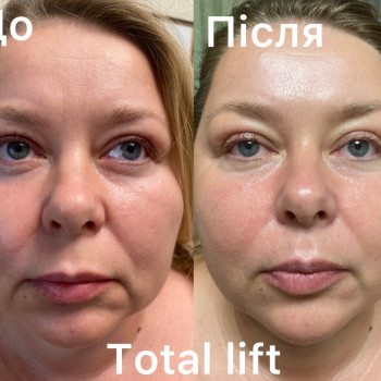 1 сеанс масажу Total Lift