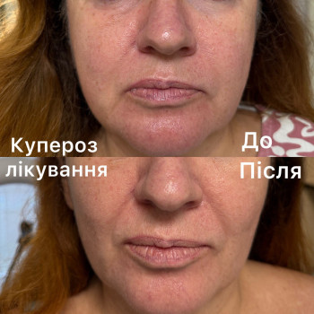Комплексне лікування куперозу