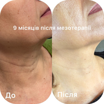 9 місяців після проведення мезотерапії