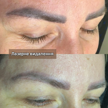 Лазерне видалення