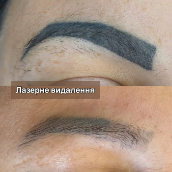 Лазерне видалення