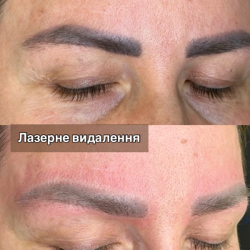 Лазерне видалення