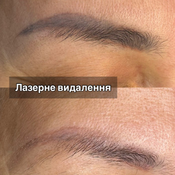 Лазерне видалення