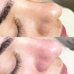 Акція червня: чистка обличчя зі знижкою 20 % Косметолог Татьяна Київ