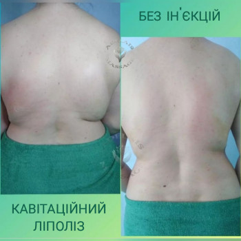 ліполітичний курс