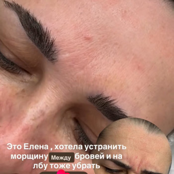 Ботокс