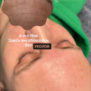 Пилинг