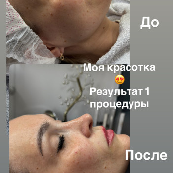 Биоревитализация