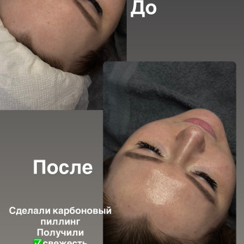 Карбоновый пиллинг