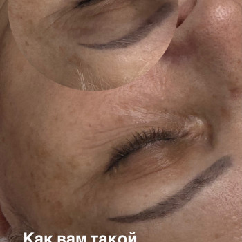 Мезотерапия