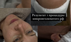 Мікроголковий рф ліфтинг Косметолог Аксиния Харків