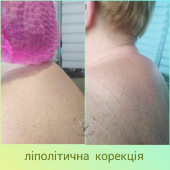 комбіноване застосування прямих й непрямих ліполітиків